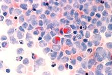 Human cells with acute myelocytic leukemia (AML) in the pericardial fluid, shown with an esterase stain at 400x.