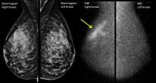 Mammogram versus molecular breast imaging