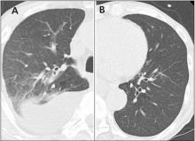 Computed tomography at the time of presentation showed infiltrates and pleural effusion in the upper lobe of the right lung (A). The left lung appeared normal (B).