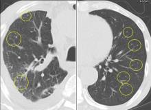 Computed tomography after 3 months of tuberculosis treatment showed randomly distributed nodules in both lungs that resembled metastatic lung cancer.