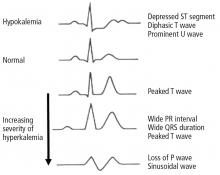 Electrocardiographic signs of hyperkalemia