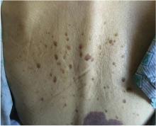 Multiple seborrheic keratoses on the patient’s upper back.