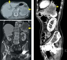 Computed tomography shows a left lung mass extending through the diaphragm and into the stomach with one metastatic lesion in the liver.