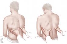 Checking for asymmetry in chest expansion, a specific but not sensitive sign of pneumonia and of pleural effusion. Left, expiration; right, inspiration.