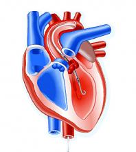 The Impella heart pump