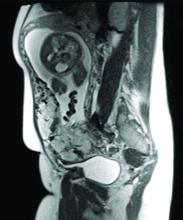 Placenta percreta shown on MRI.