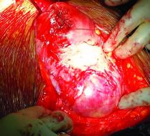 Placenta percreta is shown.