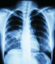 Chest x-ray showing pneumonia