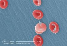 RBCs in a blood specimen of a 6-year-old boy with sickle cell disease