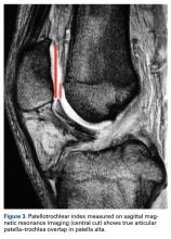 Patella Alta: A Comprehensive Review of Current Knowledge | MDedge Surgery