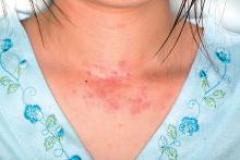 atopische Dermatitis am Hals