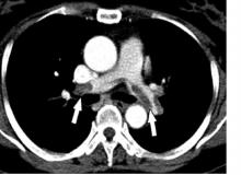 Image of a pulmonary embolism
