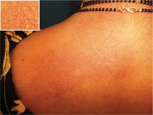 As seen in the inset, the skin-colored to hyperpigmented plane-topped papules coalesced to form a plaque over the left scapular area.