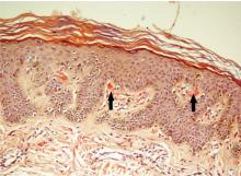 Biopsy study of the rash showed congophilic hyaline material along the tip of the papillary dermis (arrows).