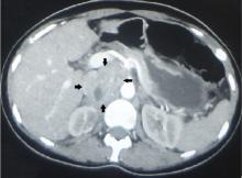 Computed tomography of the abdomen with contrast showed a heterogeneously enhancing lesion (arrows) in the right suprarenal area that measured 6.5 × 5.5 × 3.5 cm and displaced the inferior vena cava anteriorly.