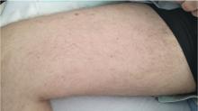 At presentation, the patient had a sparse, erythematous, macular, nonblanching rash on the lower and upper limbs.