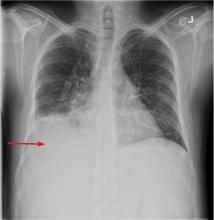 Repeat chest radiography showed a new right basilar consolidation with a small effusion (arrow).