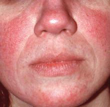 Woman with rosacea on her face.
