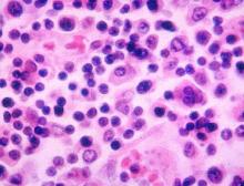 Histopathology of a lymph node in a case of typhoid fever.