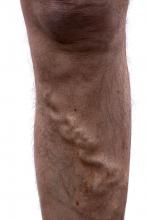 Varicose veins