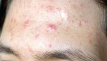 Acne on the forehead