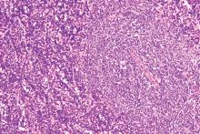 CLL leukemia