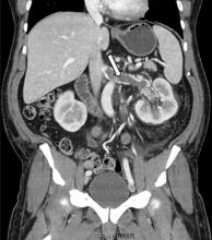 Figure 1. Coronal reformatted contrast-enhanced computed tomography showed a nearly occlusive low-attenuation filling defect within the left renal vein (arrow).