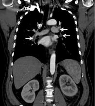 Figure 2. Coronal reformatted contrast-enhanced computed tomography of the chest showed bilateral low-attenuation filling defects in the pulmonary arteries (arrows).