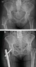 Top, an atypical femoral fracture. Bottom, after surgical repair.