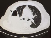 Wedge-shaped area of low attenuation suggesting a focal infarction in the collapsed and consolidated right lower lobe