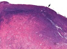 Infarcted lung with alveoli, ischemic necrosis, and a fibrinous exudate on pleural surface