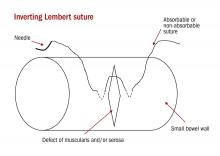 The suture line should be perpendicular to the longitudinal axis of the bowel and the suture should pass through serosal and muscular layers in Lembert stitches.