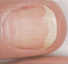 Nail Disorders And Systemic Disease What The Nails Tell Us Mdedge Family Medicine