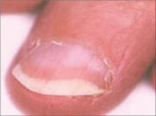 Nail Disorders And Systemic Disease What The Nails Tell Us Mdedge Family Medicine