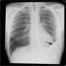 All-cause readmission rates for 227 pneumonia patients discharged over 3 months declined by 7.5 percent. 