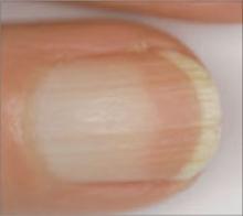 Nail Disorders And Systemic Disease What The Nails Tell Us Mdedge Family Medicine
