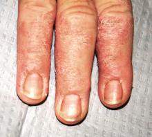 Giving providers a (diagnostic) hand with rash | Clinician Reviews