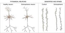 Do neural disconnects cause schizophrenia? | MDedge Psychiatry