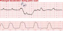 Management of prolonged decelerations | MDedge ObGyn