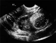 Sonography of ovarian masses: 9 key questions to guide clinical ...