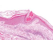 Biopsy revealed a discrete column of parakeratosis, a characteristic feature of a coronoid lamella in the epidermis, and moderate papillary dermis lymphocytic infiltrate (H&E, original magnification ×10)