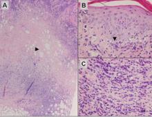 Lupus erythematosus panniculitis showing a lobular panniculitis with concomitant septal panniculi-tis (A)(H&E, original magnification ×40). Arrowhead indicates an area of hyaline sclerosis. Epidermal changes, including an interface dermatitis shown by the arrowhead, can be seen in up to half of cases (B)(H&E, original magnification ×400). Plasma cells may be a helpful clue in the diagnosis of lupus erythematosus panniculitis (C)(H&E, original magnification ×400).