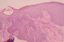 Findings from a lesional biopsy specimen demonstrated epidermal psoriasiform changes and eosinophils in the dermis. Mites were present in the stratum corneum (H&E, original magnification ×100)