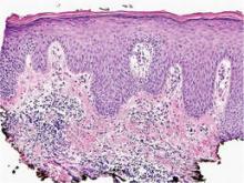 Mixed dermal inflammation with ill-formed, noncaseating granulomas (H&amp;E, original magnification ×100).