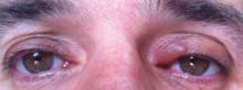 Unilateral angioedema of the left upper eyelid following use of flurbiprofen for headaches.