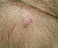 A 2.5-cm pink plaque on the scalp.