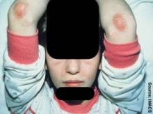 Dermatomyositis (Photo Credit: Dermatology Online Journal via Wikipedia Commons)