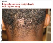 Occipital scalp papules in a teenage boy | MDedge Family Medicine