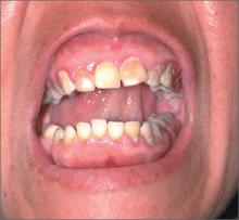 Enlarged gums | MDedge Family Medicine