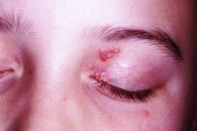 Recurrent "rash" on eyelid cause for concern? | Clinician Reviews
